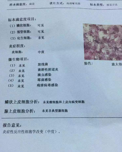 阴道分泌物91短视频免费下载厂家教你查看阴道分泌物检测报告