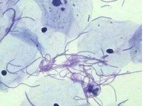 阴道分泌物91短视频免费下载厂家探讨白带清洁度3代表什么意思