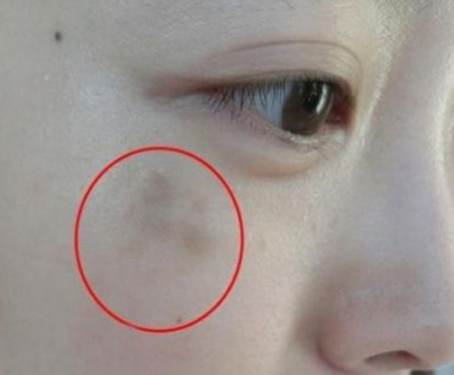 妇科阴道分泌物91短视频免费下载提醒女人妇科炎症在脸上的表现