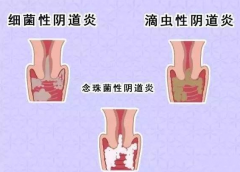 全自动阴道分泌物91短视频免费下载厂家提醒您还在拖延吗，还在等阴道炎自愈吗？